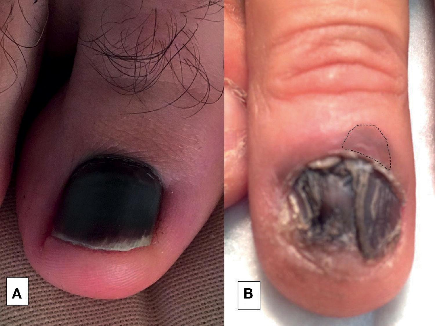 Uñas descoloridas síntoma de hongos en las uñas  Naloc